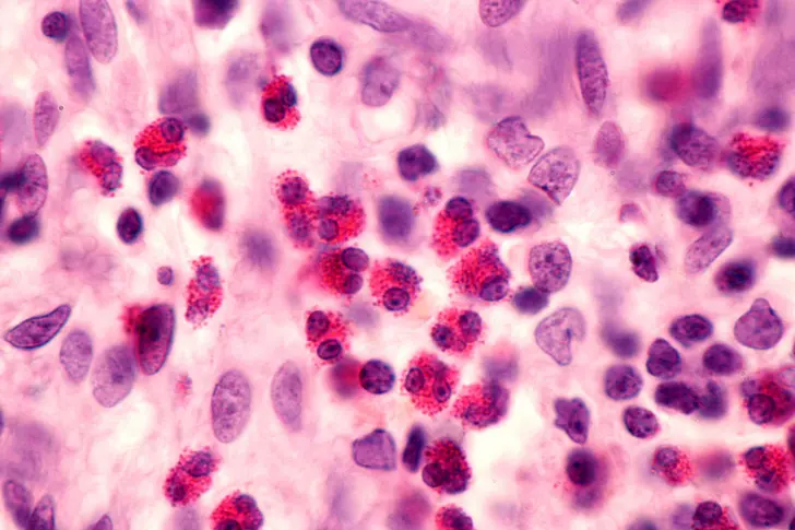 Understanding Eosinophilic Asthma Understanding Eosinophilic Asthma