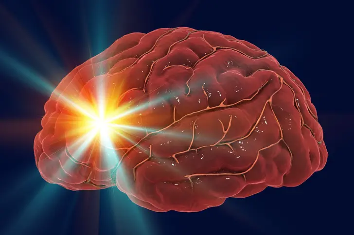 Do Migraines Cause Brain Damage?