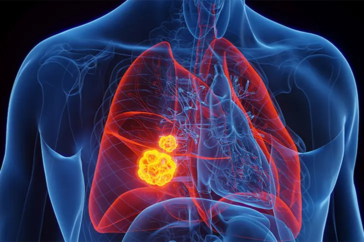 Your Best Defense Against Lung Cancer Your Best Defense Against Lung Cancer