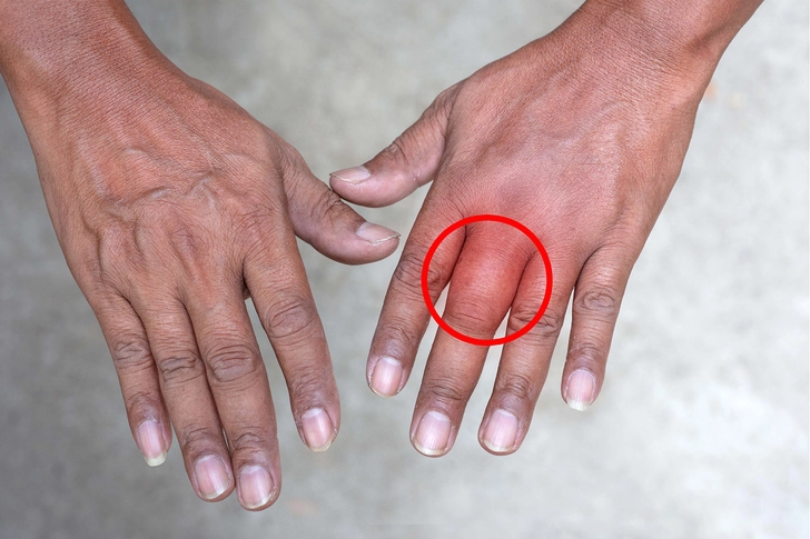 What are the Symptoms? What are the Symptoms?