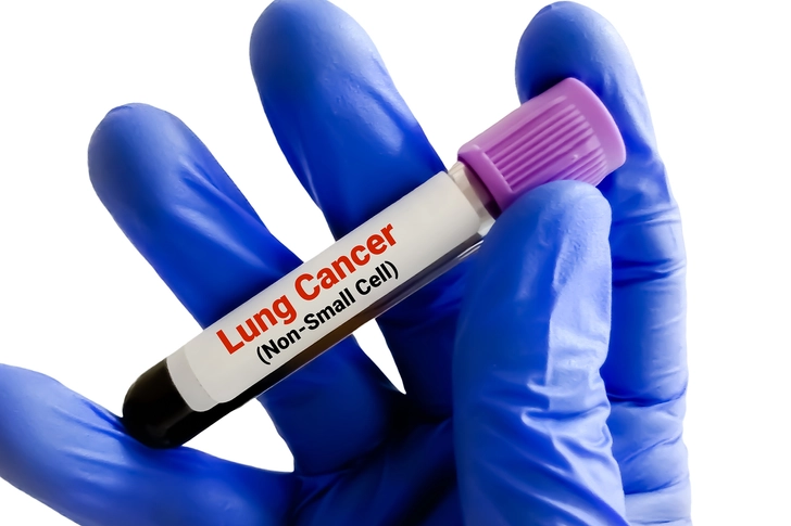 Types of Inoperable Lung Cancer Types of Inoperable Lung Cancer