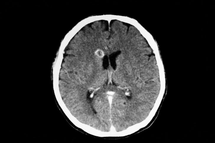Understanding Brain Lesions