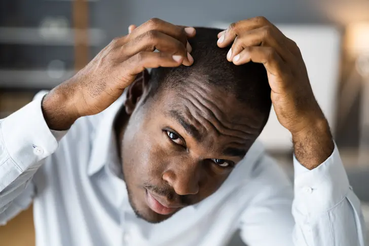 How Common Is Hair Loss?