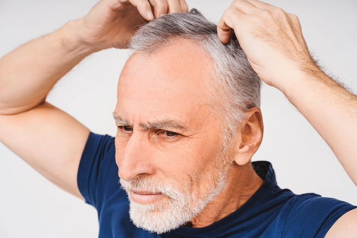 Involutional Alopecia Involutional Alopecia