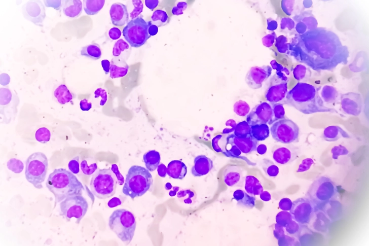 Cancer Cells Crowd Out Bone Builders