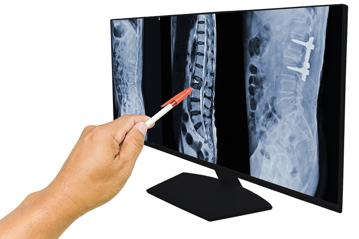 X-rays Show Bone Damage