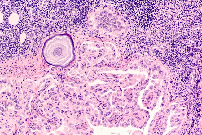 Papillary Thyroid Cancer