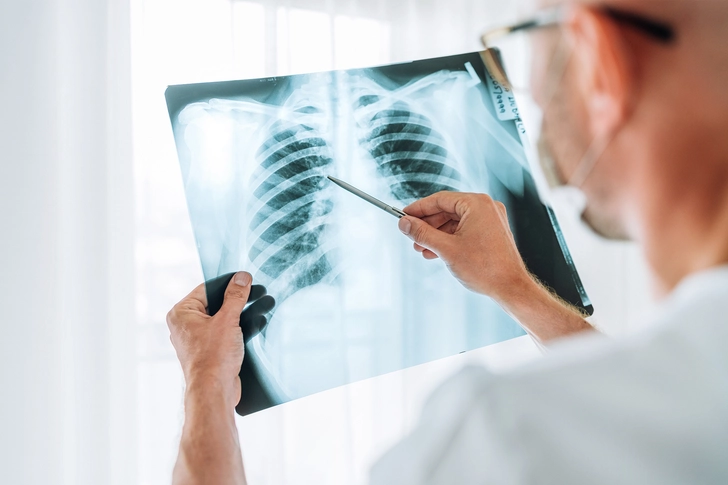 Stages of Inoperable Lung Cancer