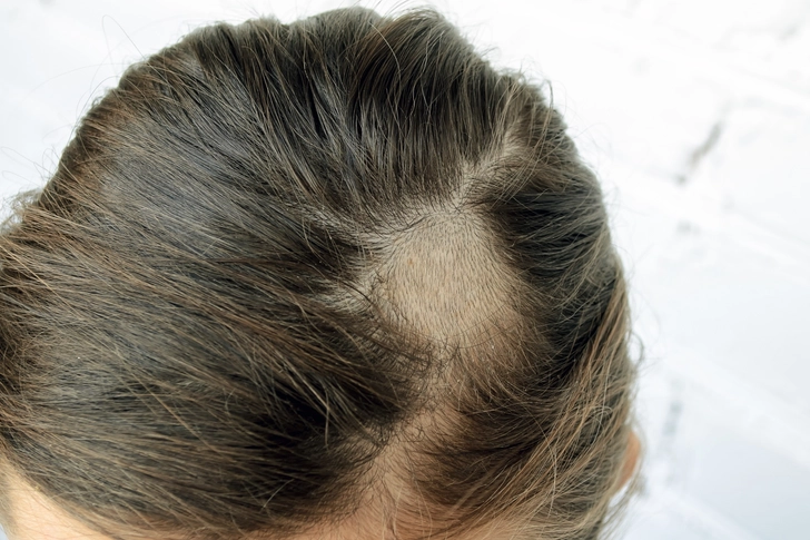 Ringworm: Contagious and Itchy