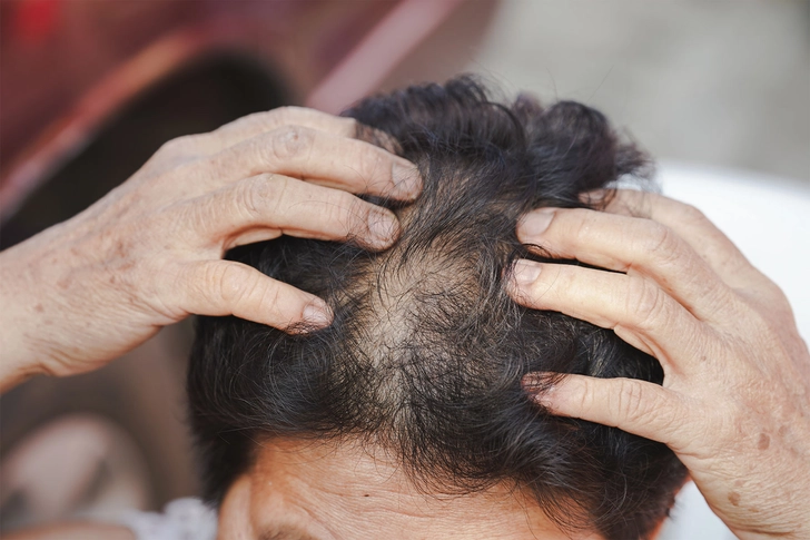 Androgenic Alopecia Androgenic Alopecia