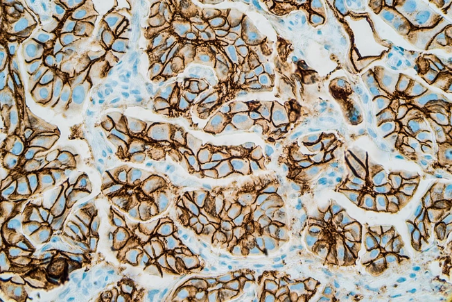 HER2-Positive Breast Cancer