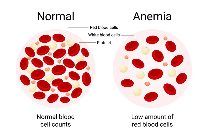 Anemia Is Common