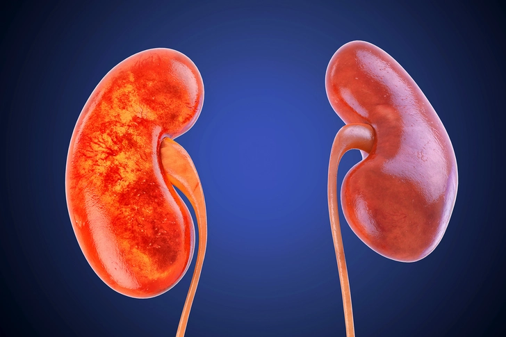 You May Develop Kidney Problems