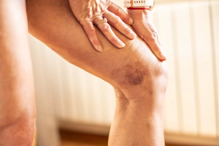 Blood Clots Are a Serious Risk