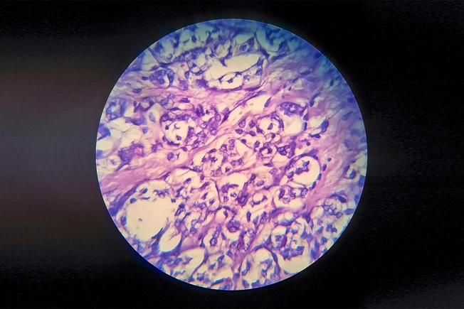Follicular Thyroid Cancer