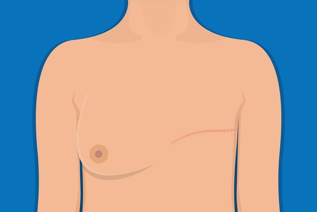 Surgery: Lumpectomy vs. Mastectomy Surgery: Lumpectomy vs. Mastectomy