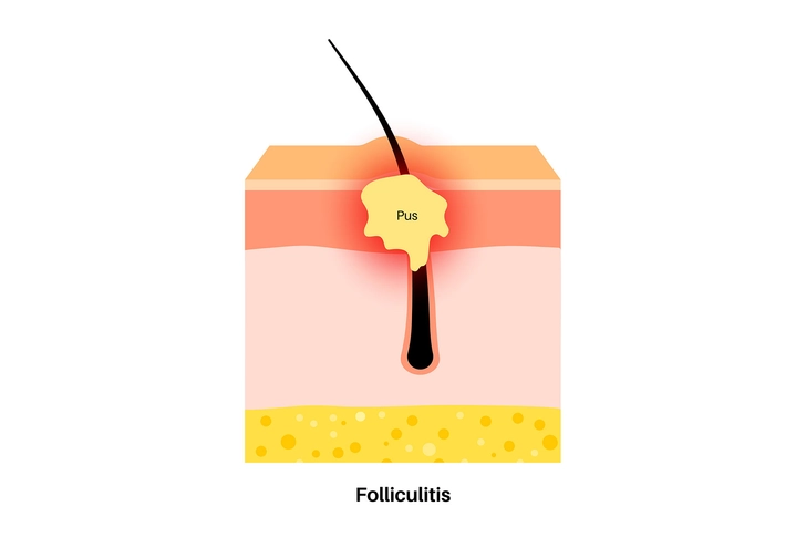 Folliculitis: Inflamed Hair Follicles