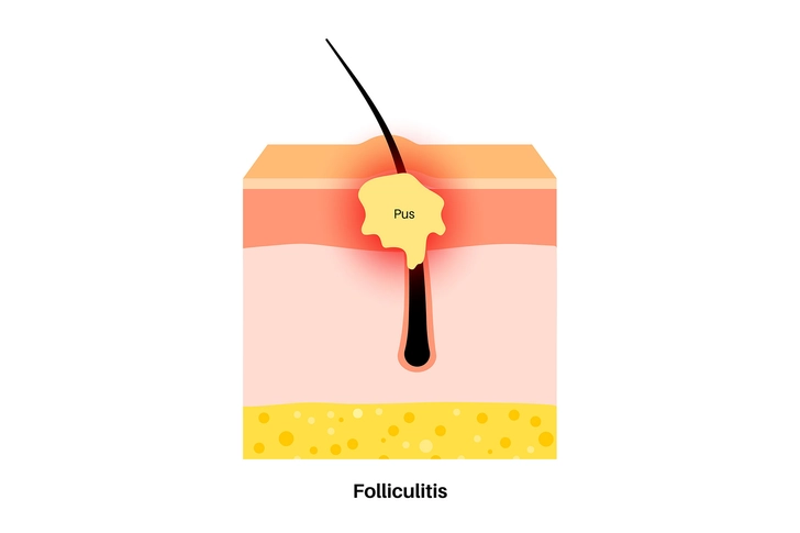 Folliculitis: Inflamed Hair Follicles Folliculitis: Inflamed Hair Follicles