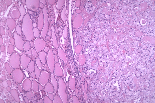 Medullary Thyroid Cancer