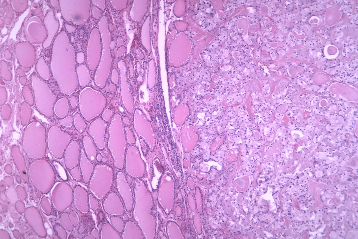Medullary Thyroid Cancer