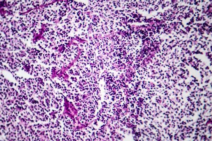 Recurrence for SCLC