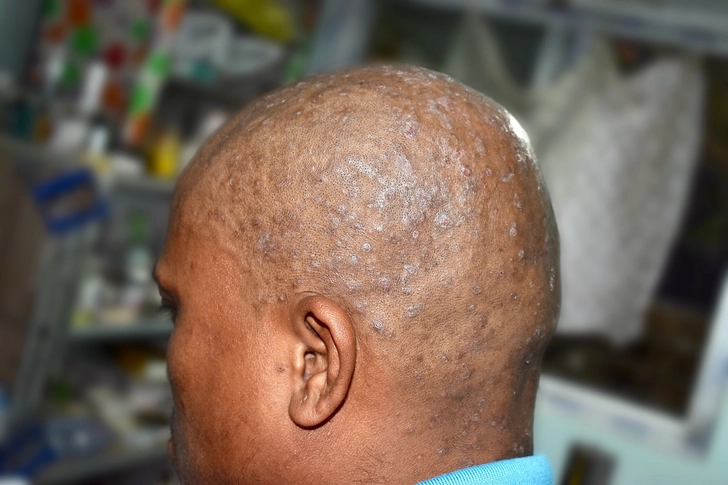 Seborrheic Dermatitis: Itchy and Flaky Scalp