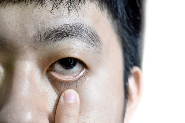 Anemia Symptoms