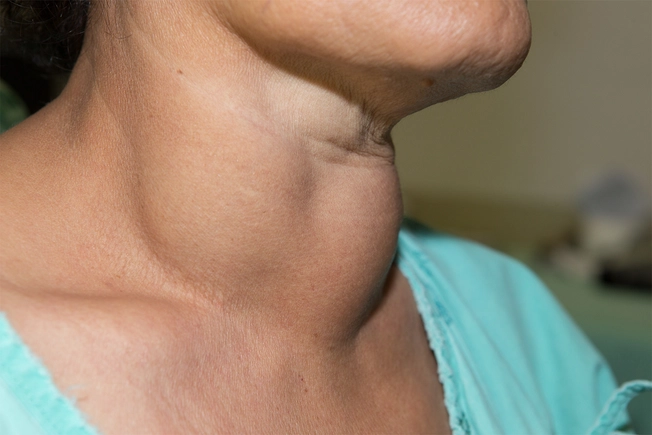 Anaplastic Thyroid Cancer