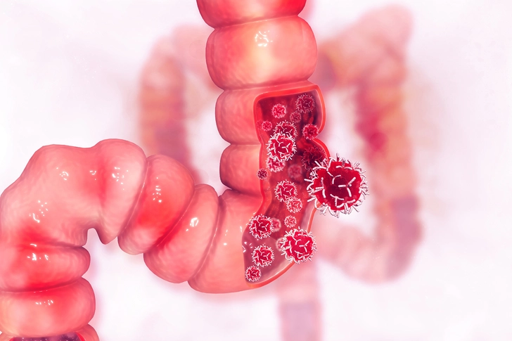 Inflammatory Bowel Disease (IBD)