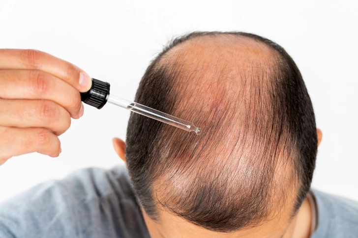 Treatment Options for Hair Loss Treatment Options for Hair Loss