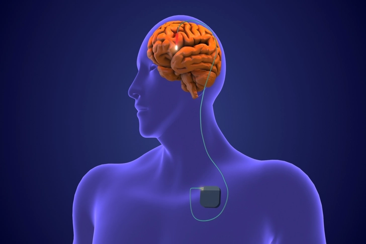 Occipital Nerve Stimulation