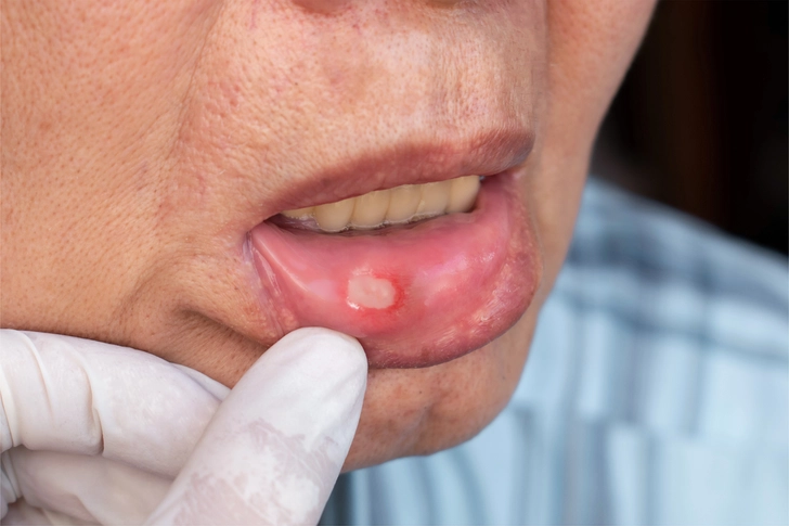 Leukopenia Symptoms Leukopenia Symptoms