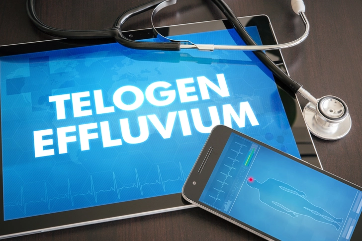 Telogen Effluvium