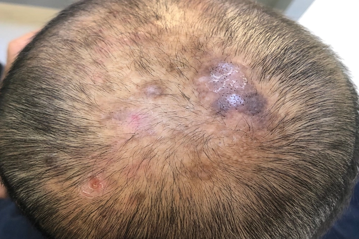 Scarring Alopecia