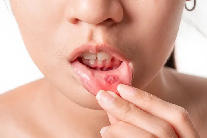Ulcerative Colitis Skin Issues