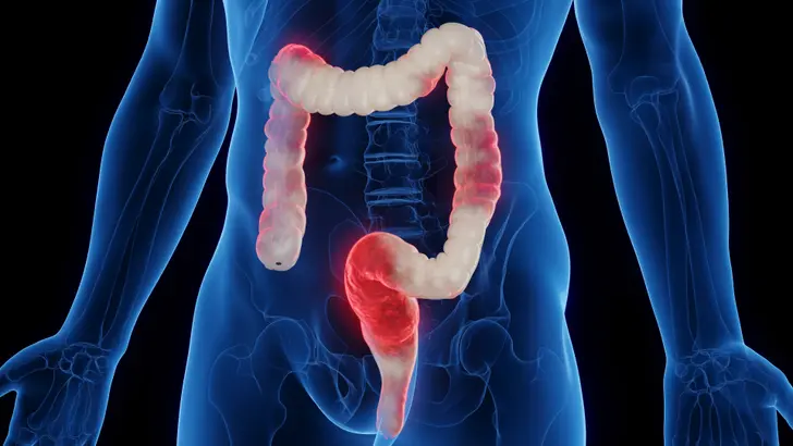 How Is Ulcerative Colitis Treated?