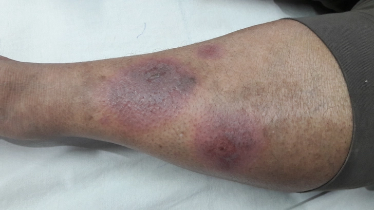 Erythema Nodosum: Painful Bumps