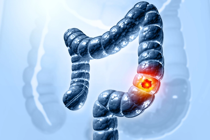 Your Risk of Colon Cancer