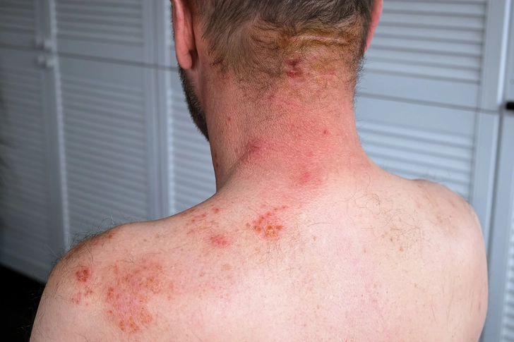 Causes of HIV-Related Pain