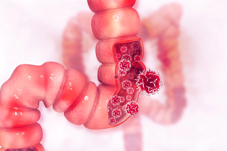 Increased Cancer Risk