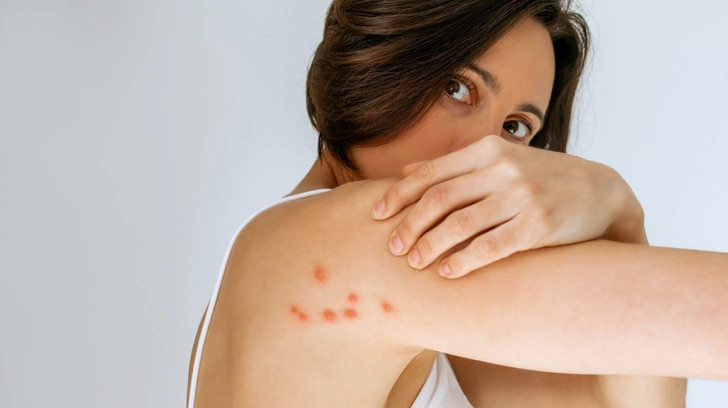 Pyoderma Gangrenosum: Rapidly Developing Ulcers