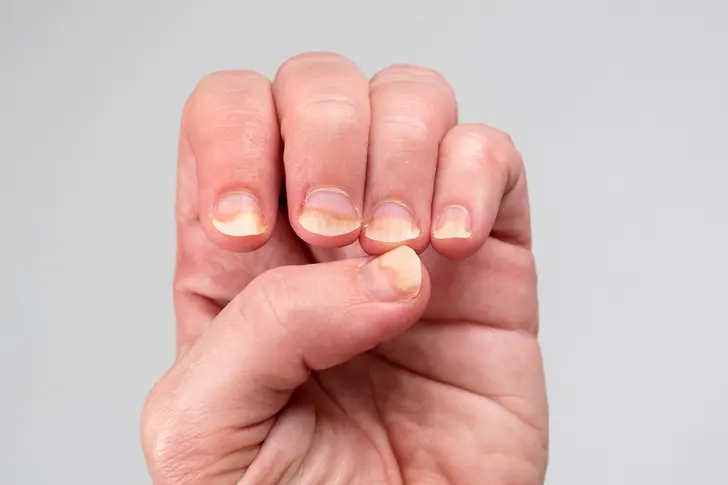 Understanding Nail Psoriasis 