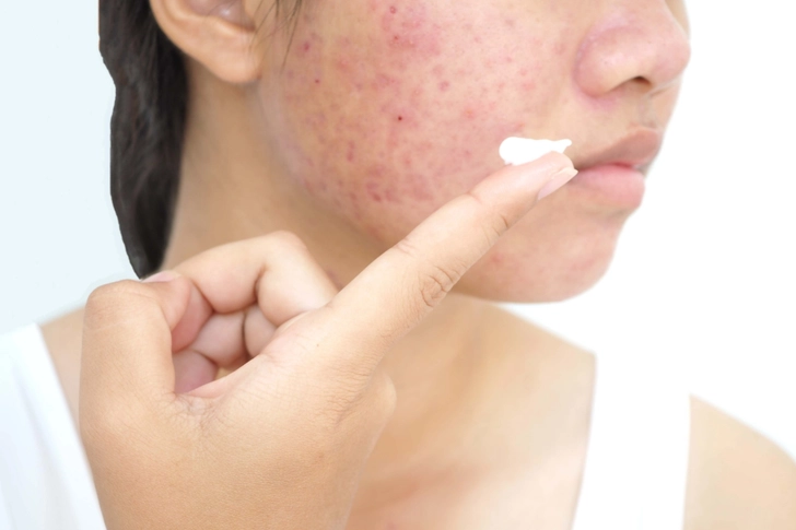 Steroidal Topical Treatments 