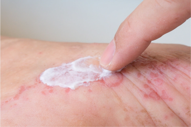 Topical Retinoids 