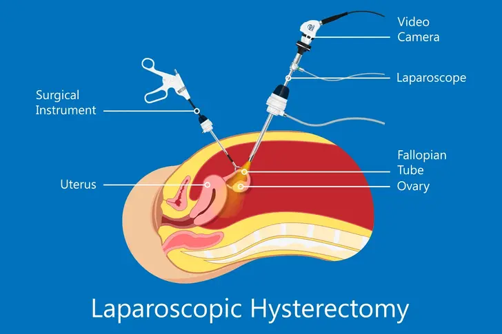 Laparoscopic Surgery for Endometriosis