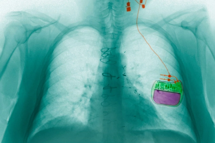 Vagus Nerve Stimulation (VNS)