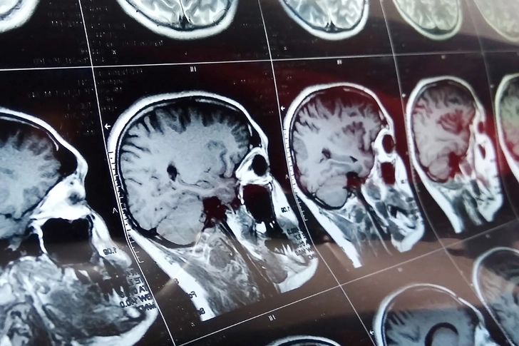Magnetic Seizure Therapy (MST)