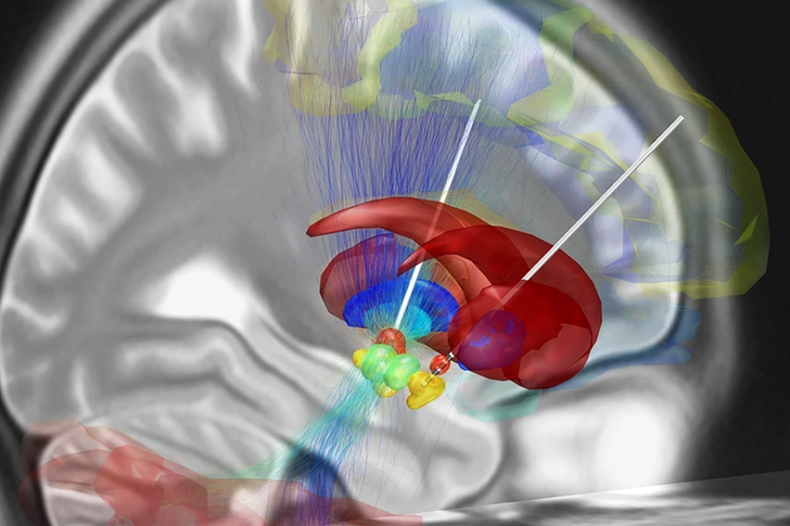 Deep Brain Stimulation (DBS)