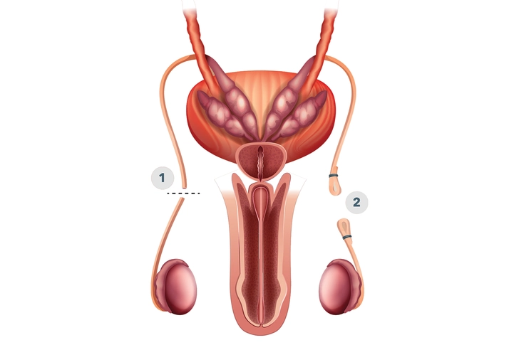 6. Non-Hormonal Contraception — RISUG