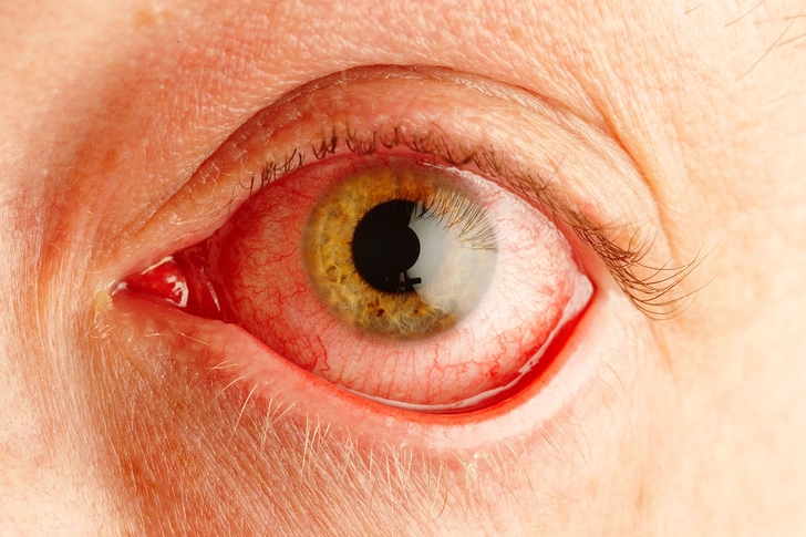 #2: Eye Infections